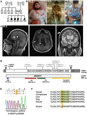 Case report: Expanding the phenotype of ARHGEF17 mutations from increased intracranial aneurysm risk to a neurodevelopmental disease